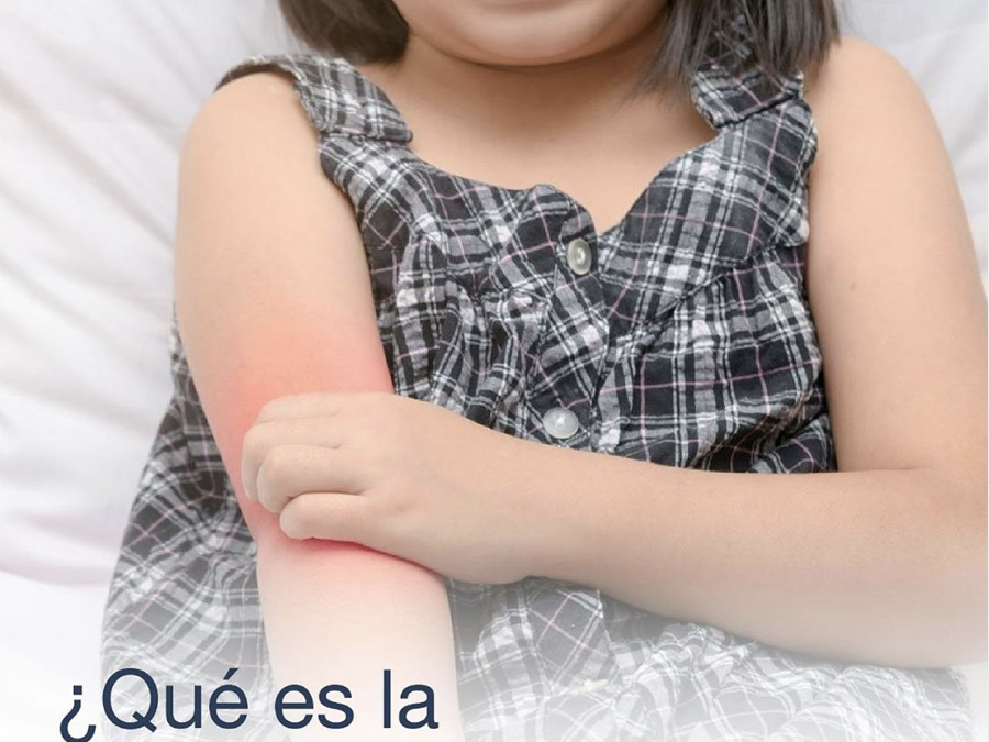 ¿Qué es la dermatitis atópica?⁣