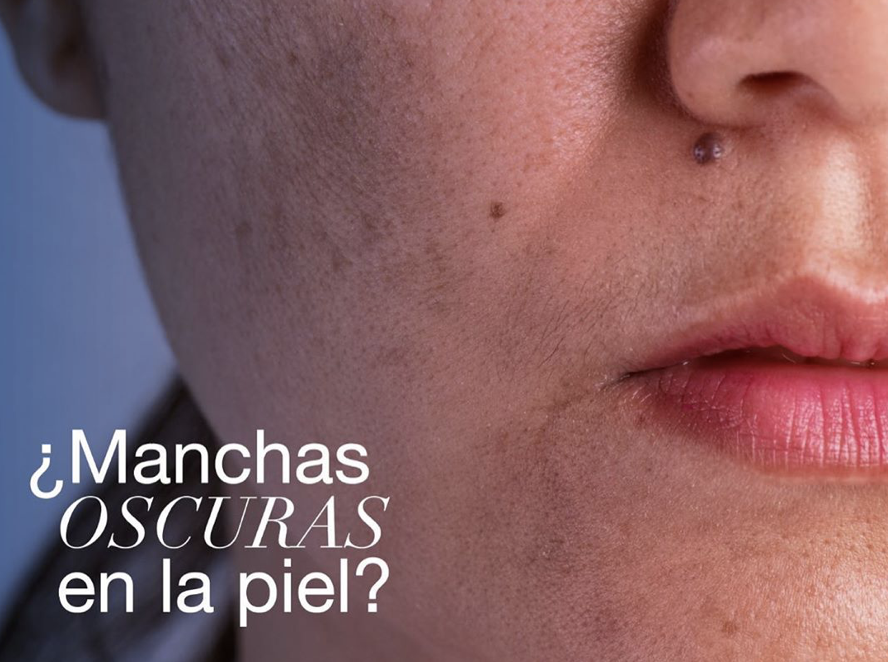 Manchas oscuras en la piel