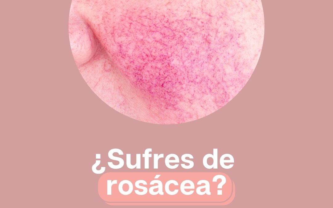 ¿Sufres de rosácea?