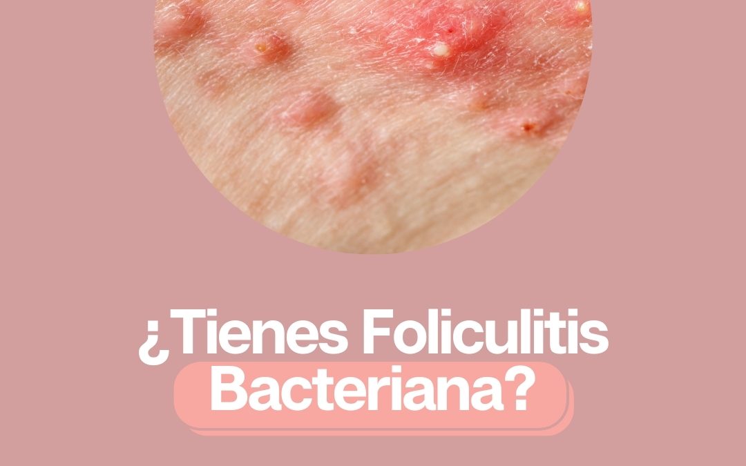 ¿Tienes Foliculitis Bacteriana?