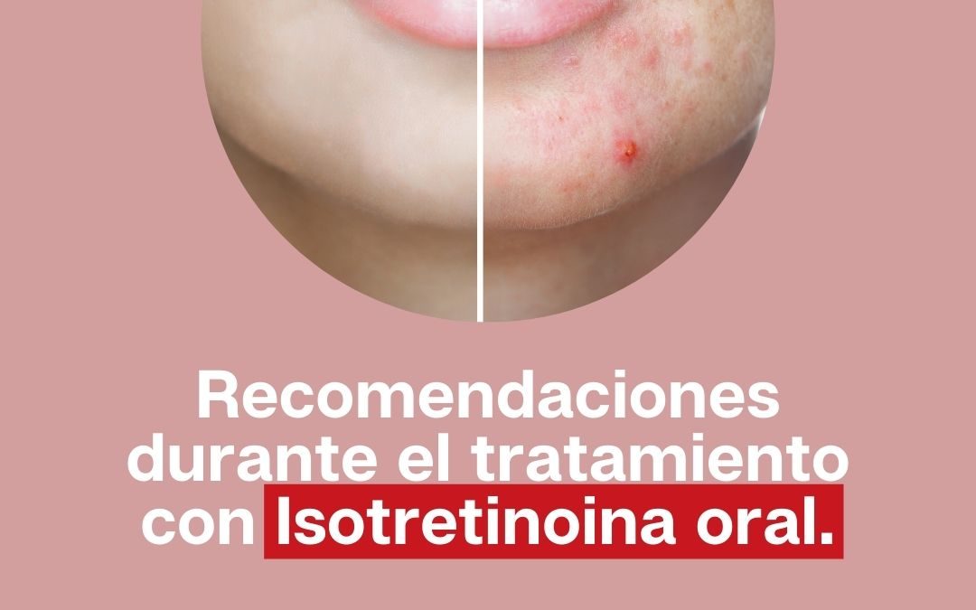 ¿Te recetaron Isotretinoina para controlar el acné?